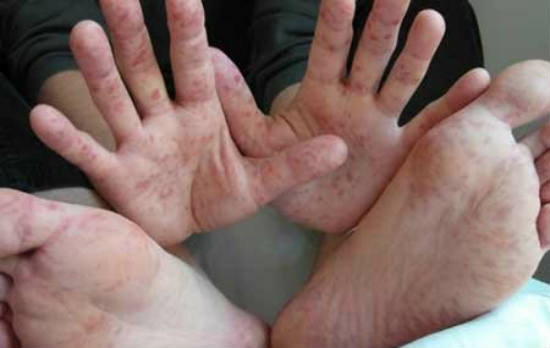 К вниманию отдыхающих: На турецких курортах бушует эпидемия коксаки koksaki_kuv.jpg